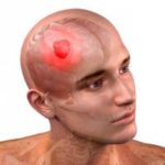 Общий анализ крови при раке головного мозга
